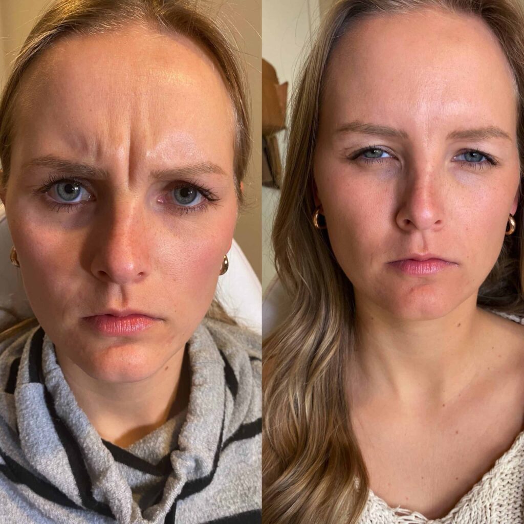 Botox And Dysport 2 Botox Before & after Treatment in Denver, CO by Preva Aesthetics LLC
