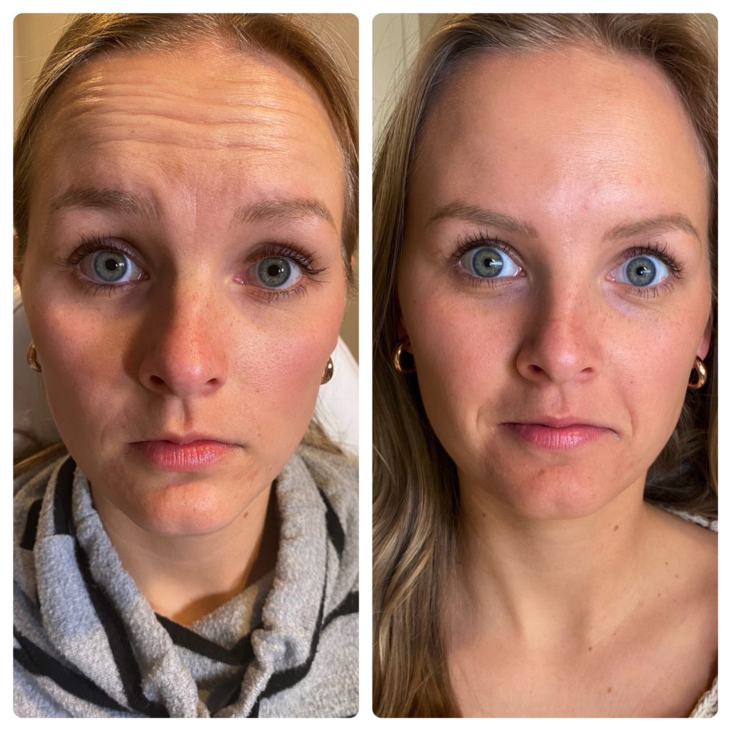 Botox Before & after Treatment in Denver, CO by Preva Aesthetics LLC