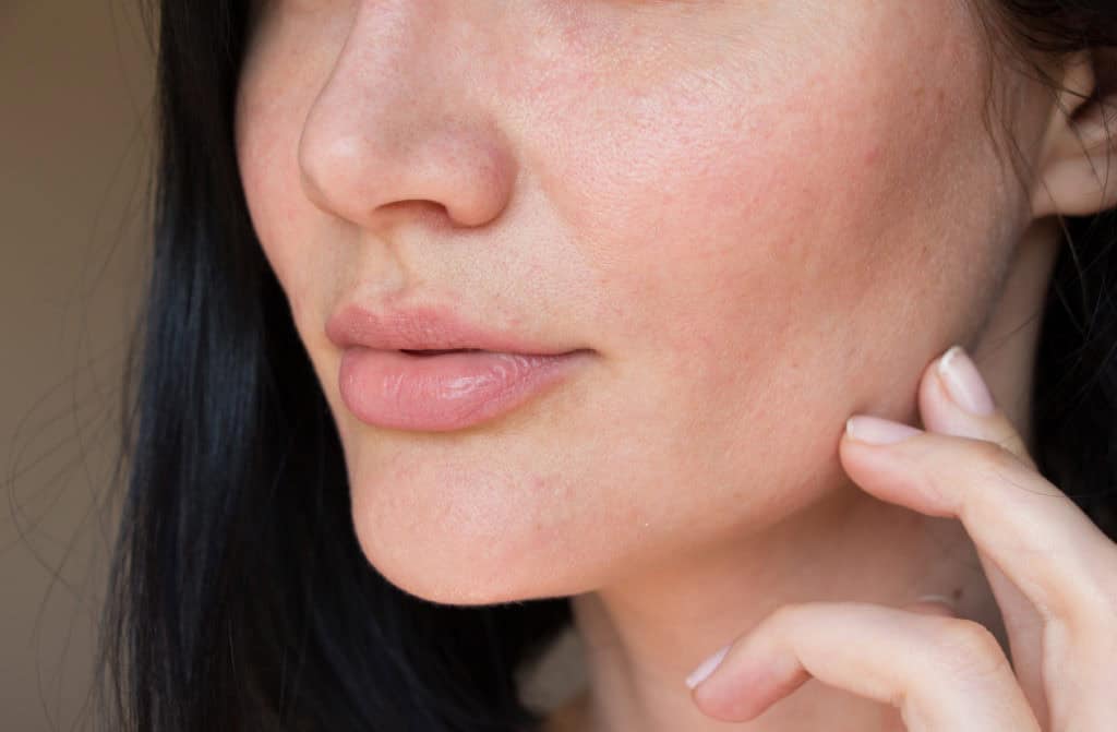 Buzzword: Hyaluronic Acid. What is it and why do you need it? 9 problem skin of the face acne on the face pores on the face