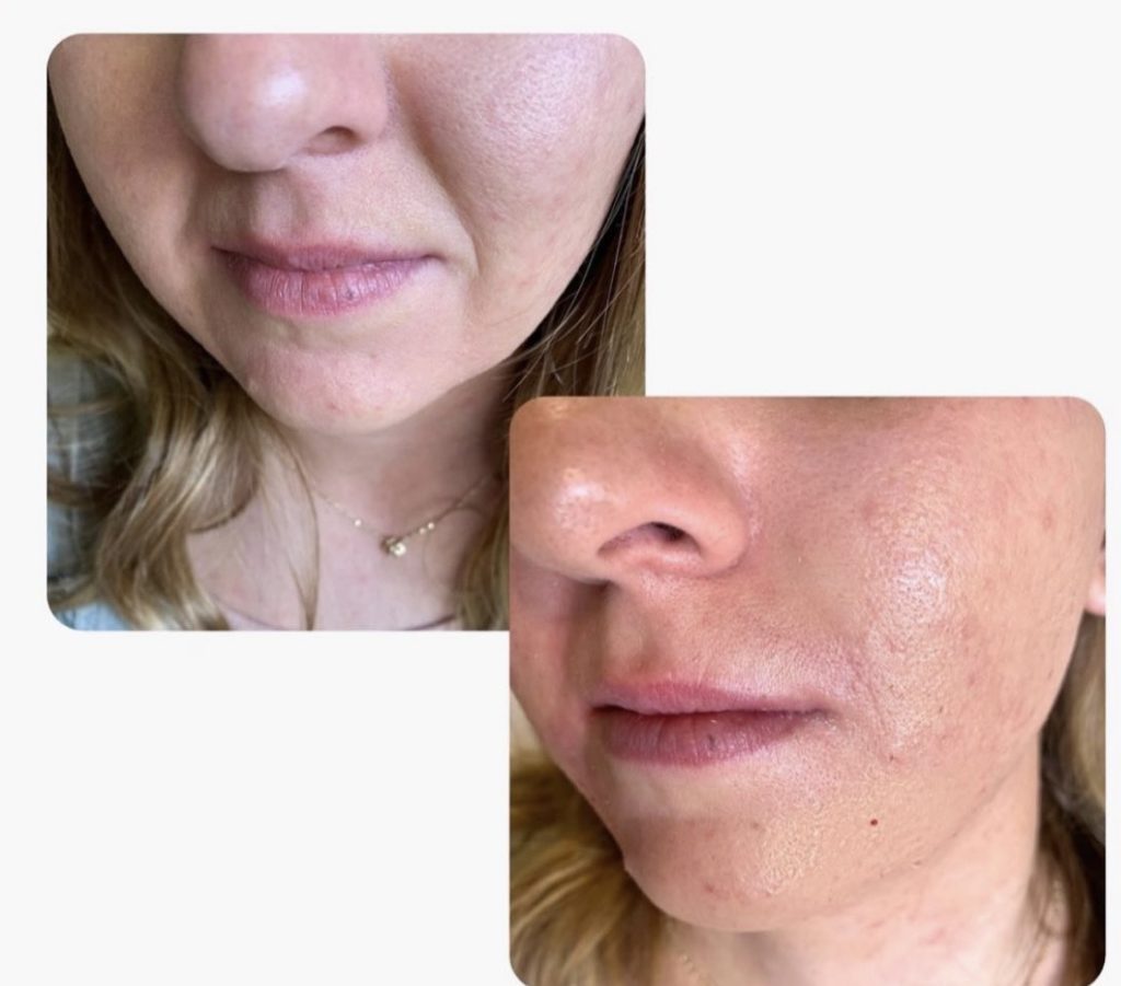 Botox Before & after Treatment in Denver, CO by Preva Aesthetics LLC