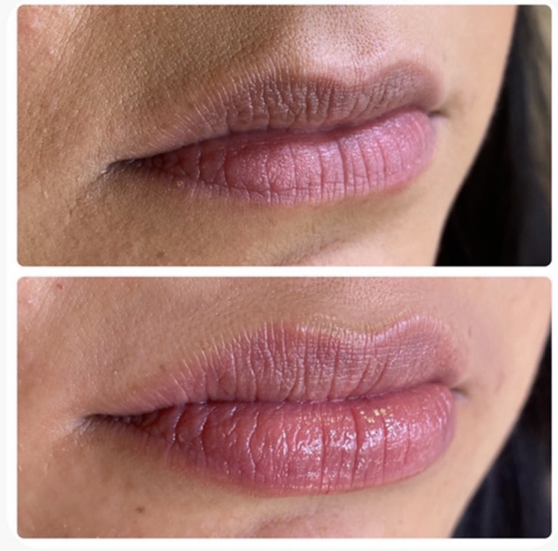 Fillers Before & after Treatment in Denver, CO by Preva Aesthetics LLC